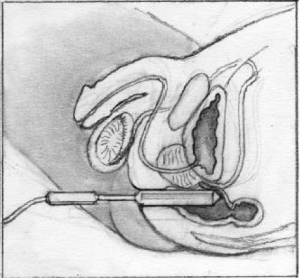 electroejaculation OR spinal cord injury